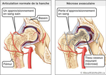 Articulation avec de tissu osseux mourant à cause d'une perte d'approvisionnement en sang