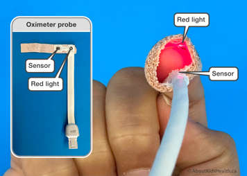 Wrapping an oximeter probe around a child’s finger showing the red light on one side and the sensor on the other. An inset shows the oximeter probe with the sensor and red light labelled.