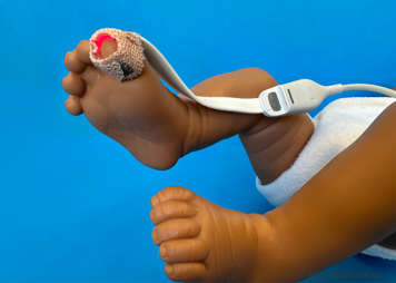 A probe wrapped around a child's toe