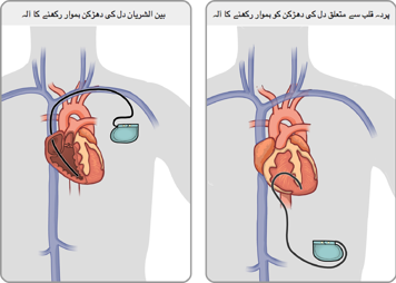 قلب میں لگا وریدوں میں داخل کیا جانے والا پیس میکر اورقلب کے باہرلگانے والے پیس میکرکا مقام