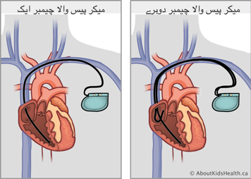 ایک چیمبر والا پیس میکر بمقابلہ دو چیمبر والا پیس میکر، جو ورید میں سے گزرتا اور قلب میں لگتا ہے