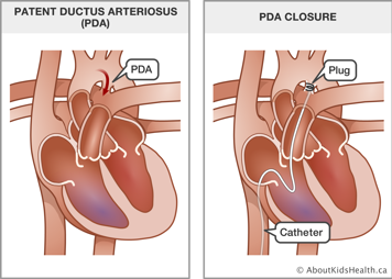 A heart with patent ductus arteriosus and a heart with a catheter and plug inserted to close the PDA