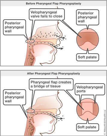 Pharyngeal flap surgery