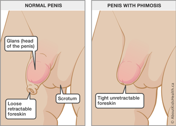 Normal penis with loose retractable foreskin and penis with phimosis with tight unretractable foreskin