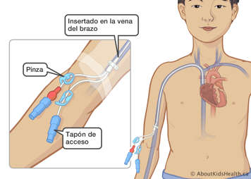 Catéter insertado en la vena del brazo de un niño con una pinza y un tapón de acceso en el exterior