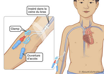 Un cathéter inséré dans la veine du bras d’un enfant avec un clamp et une ouverture d’accès à l’extérieur