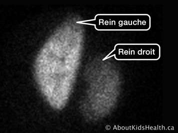 Les reins gauche et droit dans une scintigraphie rénale au DMSA