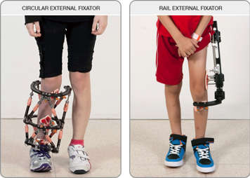 A circular external fixator and a rail external fixator