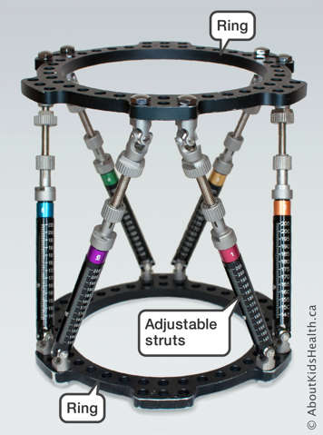 Rings and adjustable struts on a Taylor Spatial Frame