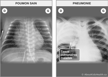 Une radiographie aux rayons X des poumons sains et une radiographie des poumons avec des tissus pulmonaires malades