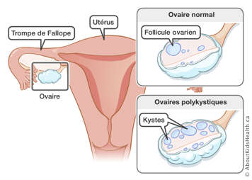 Emplacement de l’ovaire par rapport à l’utérus avec parallèle entre un ovaire normal et un ovaire polykystique typique endommagé par le syndrome des ovaires polykystiques (SOP)