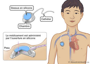 Identification du dessus en silicone, la chambre et le cathéter d’un Port-a-Cath sous la peau de la poitrine