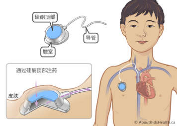 经皮下置入儿童胸腔主静脉的端口装置中的硅酮顶部、腔室和导管