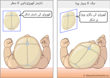 اوپر سے دیکھنے پرکھوپڑی کی نارمل شکل و صورت اور سپاٹ پوزیشن کی وجہ سے کھوپڑی کی بگڑی ہوئی شکل