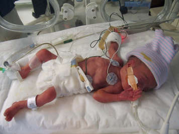 Very preterm baby lying in an isolette