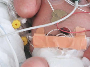 preemie with an umbilical venous catheter, which is a line connected through the tail of the cut umbilical cord