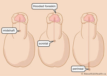 The urinary opening can be somewhere between the midshaft of the penis and perineum, and the foreskin is hooded.