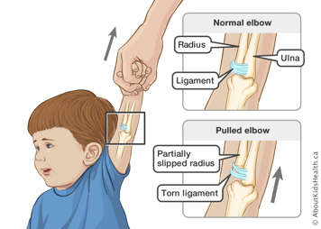 Radius, ulna and ligament in normal elbow, and partially slipped radius and torn ligament in pulled elbow