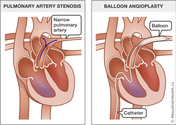 Heart with narrow pulmonary artery and heart with catheter and balloon inserted through arteries