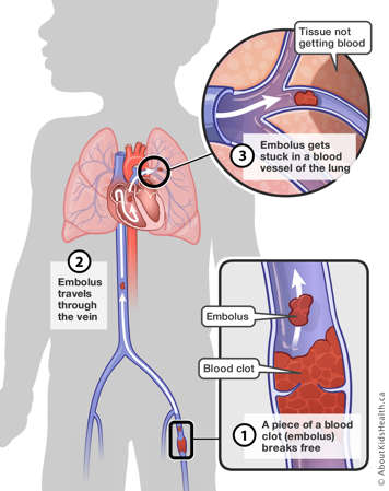 Piece of a blood clot breaking free in the leg, traveling through the vein and getting stuck in a blood vessel in the lung