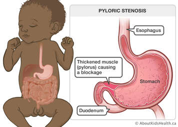 A baby’s esophagus, stomach and duodenum, with a thickened muscle (pylorus) causing a blockage below the stomach