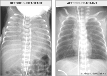 Respiratory distress syndrome x-rays taken before and after administration of surfactant