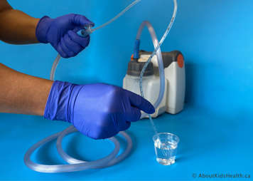 Holding thumb on a tracheostomy suction catheter suction control port while suctioning sterile water