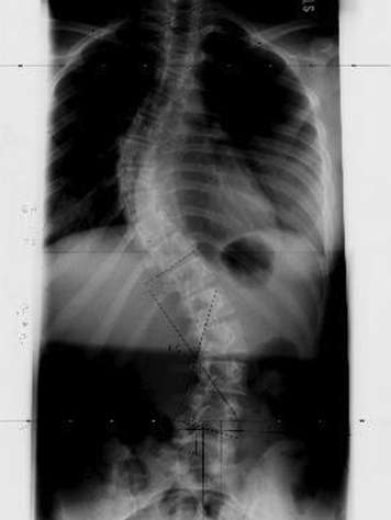 Rayons X d'une colonne vertébrale atteinte de scoliose