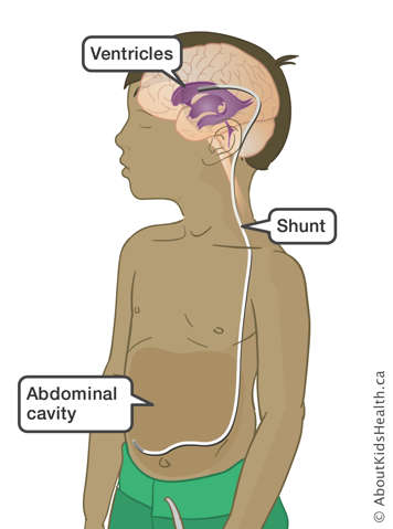 Shunt running from the ventricles of a boy’s brain and down to his abdominal cavity