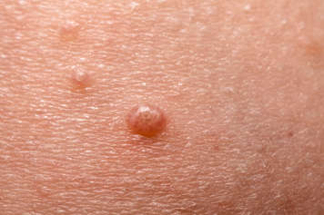 child with bumps caused by molluscum contagiosum on their skin