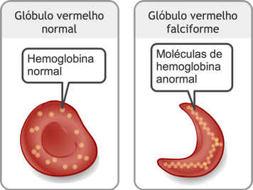 Glóbulo vermelho com moléculas de hemoglobina normais e glóbulo vermelho falciforme com moléculas de hemoglobina anormais