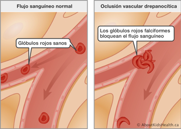 Flujo sanguíneo normal con glóbulos rojos sanos comparado con flujo sanguíneo bloqueado por glóbulos rojos falciformes