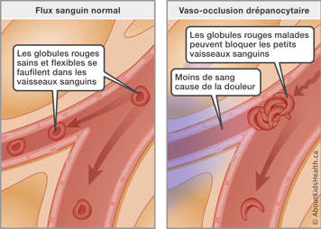 Flux sanguin normal avec globules rouges sains comparé aux globules malades bloquant la circulation sanguine