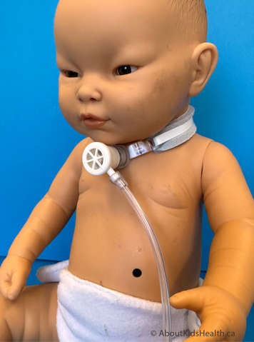 Child wearing a Passy Muir Valve (PMV) Oxygen Adapter.