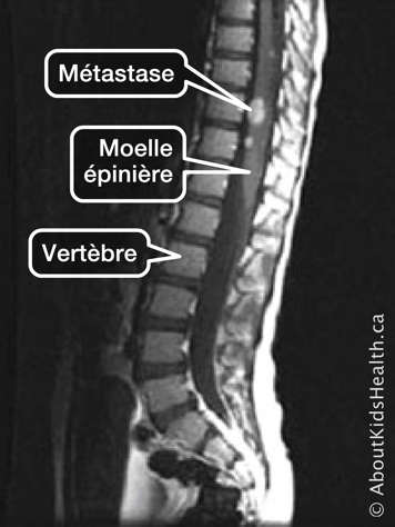 Un balayage montrant la vertèbre et la moelle épinière avec des métastases