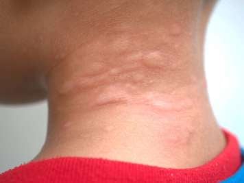 Raised hives on the back of a child's neck