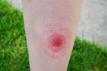 Lyme disease rash on a leg