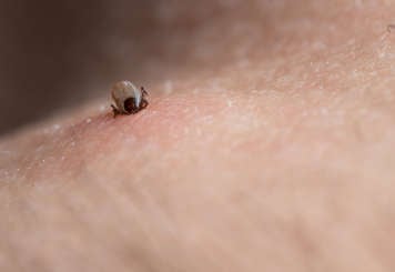 Blacklegged tick embedded on a person