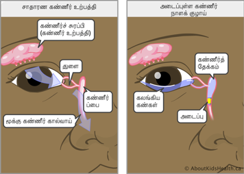 சாதாரணமான கண்ணீர் உற்பத்தி செய்யும் கண் மற்றும் கண்ணீர் கால்வாய் தடைப்பட்டதால் கண்ணீர் சுரப்பிப் பையில் கண்ணீர் தேங்கல் மற்றும் நீர்த்தன்மையான கண்கள்