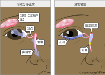 泪液分泌正常的眼睛,以及泪管阻塞的眼睛,后者会导致眼泪在泪囊中积聚,使患者多泪
