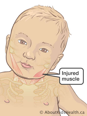 Injured muscle in baby’s neck and cheek