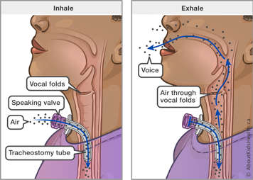 Illustration showing that with a one-way speaking valve air comes in through the tracheostomy tube but during exhale air goes out past the vocal folds