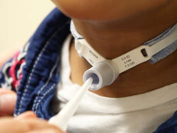 Suctioning a tracheostomy tube with a tip adaptor