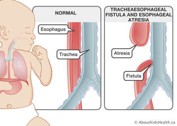 Normal esophagus and trachea, and an illustration of tracheoesophageal fistula and esophageal atresia