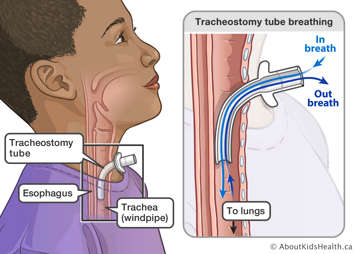 A tracheostomy tube goes into the trachea and functions as a breathing tube.