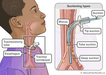 Tip, tube, deep suctioning lengths in a cross section anatomy drawing