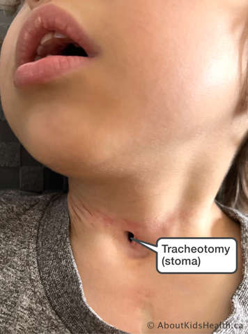 Child with a tracheotomy or stoma