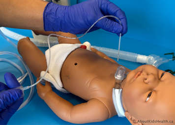 Removing the tracheostomy suction catheter