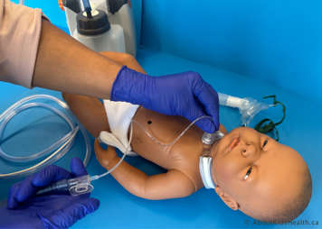 Inserting a tracheostomy suction catheter into a tracheostomy tube