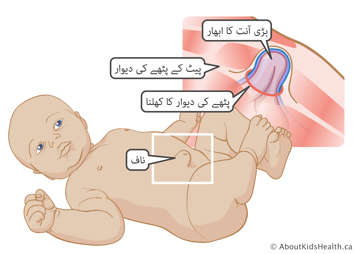 بچےکے پیٹ کے پٹھےکی دیوار میں سوراخ سے نکلنے والی پھولی ہوئی آنت کا خاکہ 